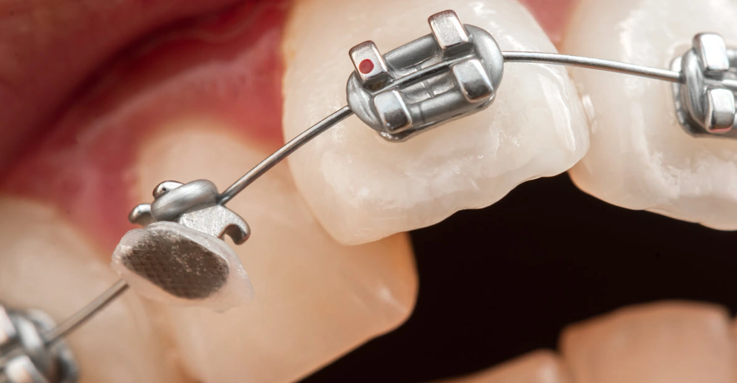 What to Do During Orthodontic Emergencies Inblog